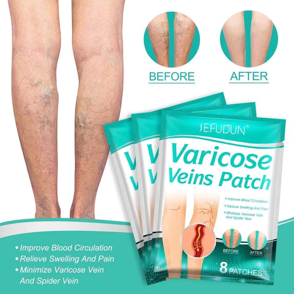 Varicose Veins Leg Exercise To Improve Blood Circulation Blood